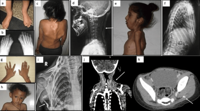 Microdactaly Fibrodysplasia Ossificans Progressiva (FOP) – 1/1,000,000 People ...