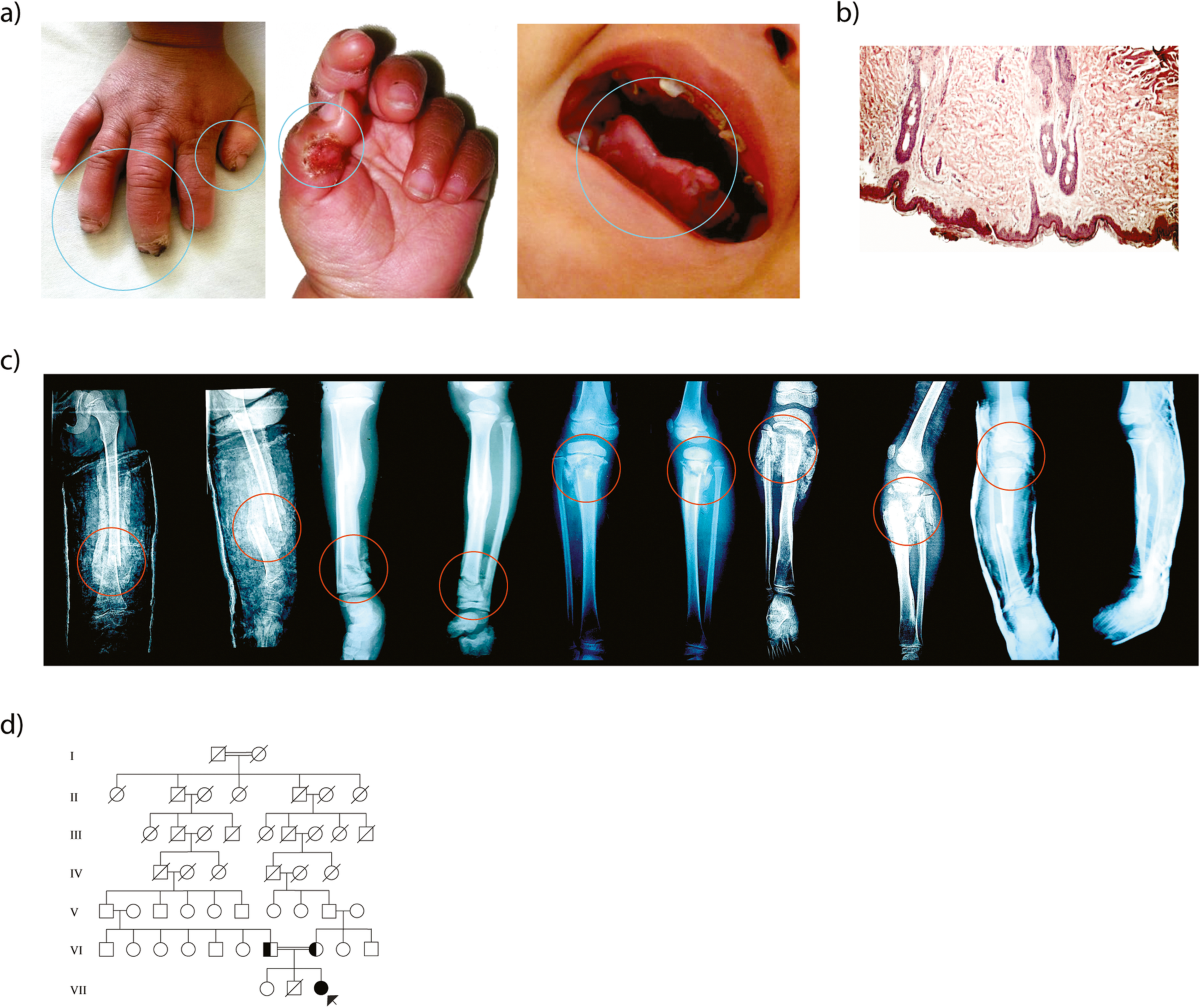 Congenital Insensitivity to Pain (CIP) – 1 in a Million People – Rare ...