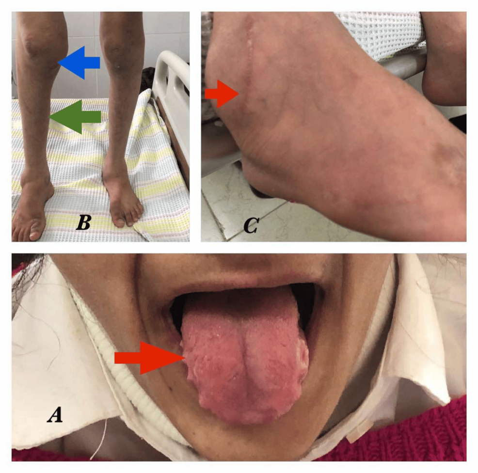 Congenital Insensitivity to Pain (CIP) – 1 in a Million People – Rare ...